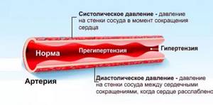 Гомеопатия Варикоз И Повышенное Давление