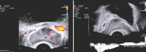 Флебография малого таза у мужчин. Вены перипростатического сплетения. Трансректальное узи простаты. Флебография варикоцеле. Расширение вен парапростатического венозного сплетения.