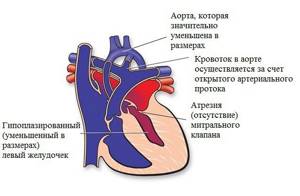 Левых отделов. Синдром гипоплазии левых отделов сердца. Гипоплазия левого желудочка. СГЛС врожденный порок сердца.