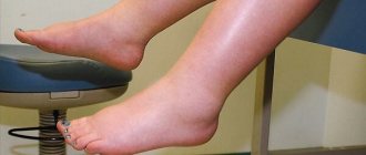 Anasarca - symptoms and treatment, photos and videos.