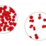 Anemia: types, main symptoms