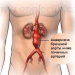 Abdominal aortic aneurysm