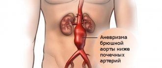 Abdominal aortic aneurysm