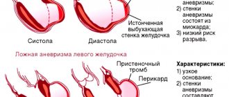 Aneurysm