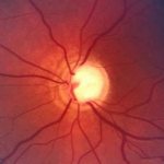 Ангиопатия сетчатки симптомы