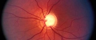 Retinal angiopathy symptoms