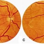 Ангиопатия сетчатки симптомы