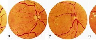 Retinal angiopathy symptoms