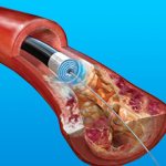 Ангиопластика лазером