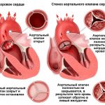 Аортальная недостаточность (2).jpg