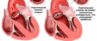 Аортальная недостаточность (2).jpg