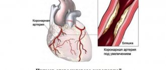 Atheroskerosis