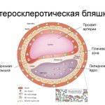 Atherosclerotic plaque