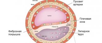 Atherosclerotic plaque