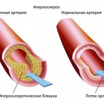 atherosclerosis1