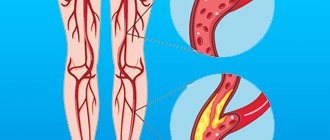 Atherosclerosis