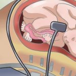 Pregnancy in patients with bradycardia