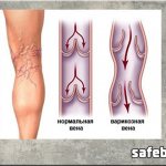 Do they take you into the army with varicose veins?