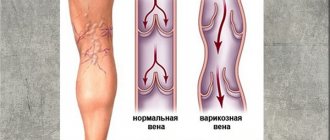 Do they take you into the army with varicose veins?