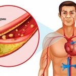 Blockage of arteries by cholesterol
