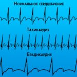 Брадикардия у спортсменов