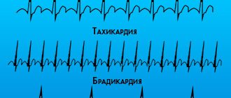 Брадикардия у спортсменов
