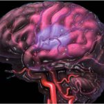 cerebral ischemia grade 2 in newborns consequences