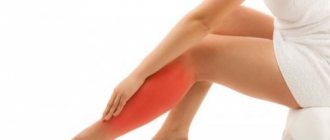 Чем лечить варикоз: топ-9 лучших мазей