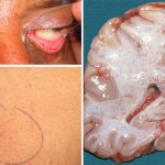 What is a fat embolism and how to treat it