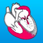 What is mitral stenosis