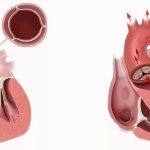 What is heart disease