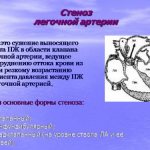 What is pulmonary stenosis