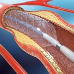 Cтентирование при атеросклерозе