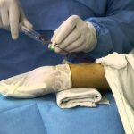 Декомпрессионная (кессонная) болезнь