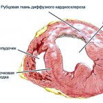 Диффузный кардиосклероз