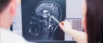 Дисциркуляторная энцефалопатия