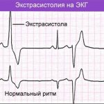 Patient diary during daily monitoring sample