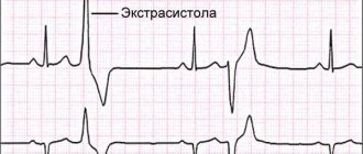 Дневник пациента при суточном мониторировании образец