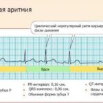 Дыхательная синусовая аритмия