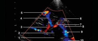 Echogram (CDC mode) - middle cerebral artery, transtemporal access