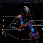 Эхограмма (режим ЦДК) - средняя мозговая артерия, транстемпоральный доступ