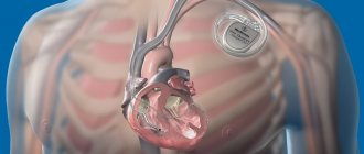 Pacemaker saves lives