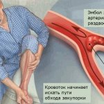 Embolism is one of the common causes of acute arterial insufficiency