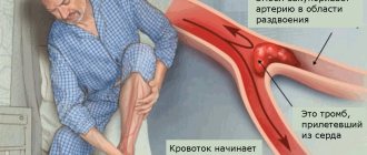 Эмболия является одной из частых причин острой артериальной недостаточности