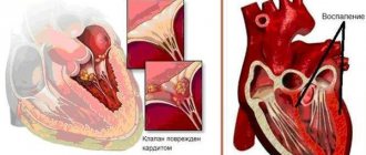 Endocarditis and myocarditis