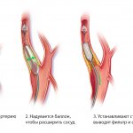 Stages of stent installation