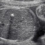 The &quot;golf ball&quot; phenomenon