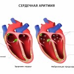 Atrial fibrillation.jpg