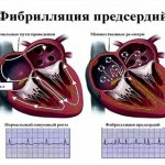 Atrial fibrillation