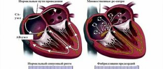 Atrial fibrillation